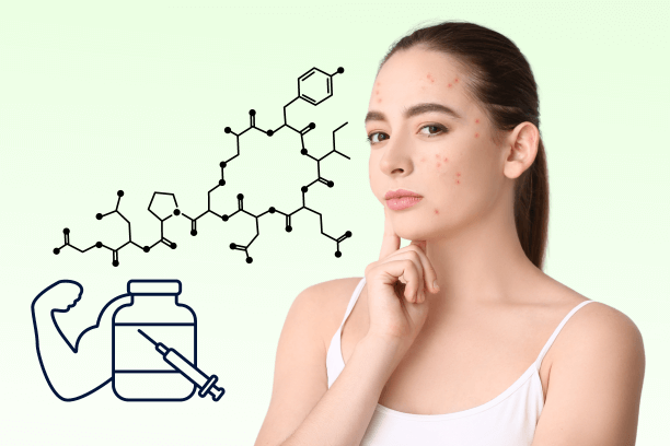 Steroids and Acne